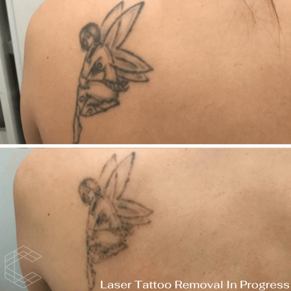 Laser Tattoo Removal