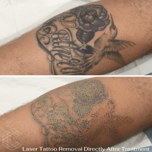 Laser Tattoo Removal - Tatoo Removal Brisbane, Bendigo, Canberra