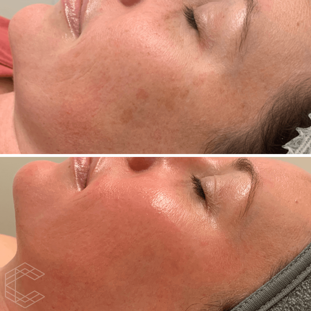 Cosmelan Peel & Depigmentation Treatments Cosmelan Brisbane, Bendigo, Canberra