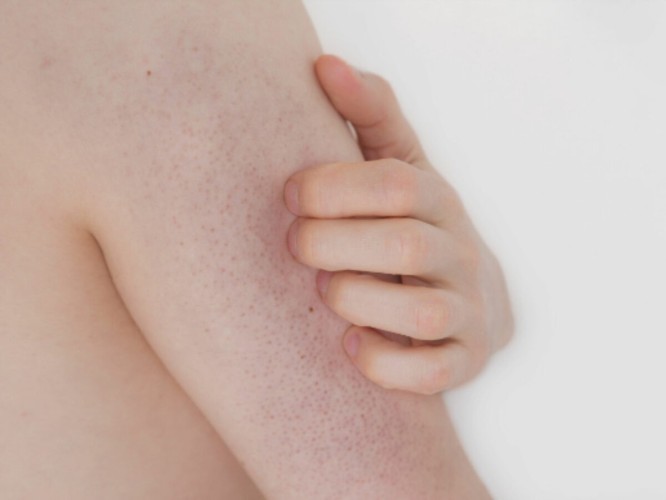 Keratosis Pilaris