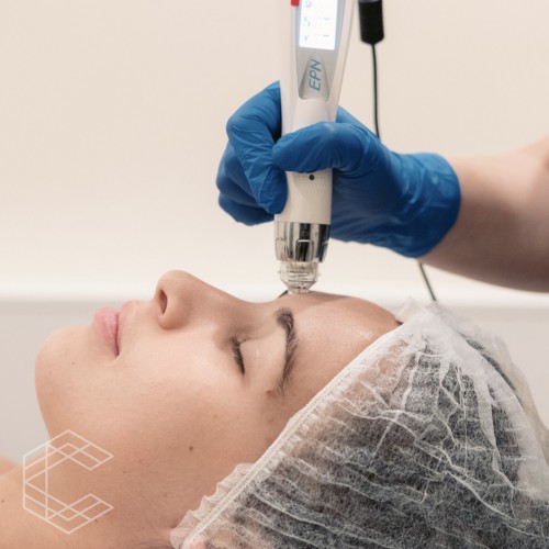 Skin Needling